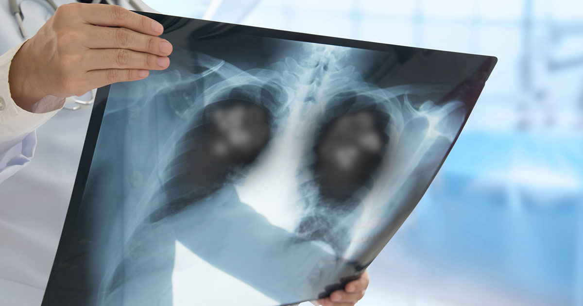 Strokovnjaki opozarjajo: Ta rak se med ženskami širi z alarmantno hitrostjo