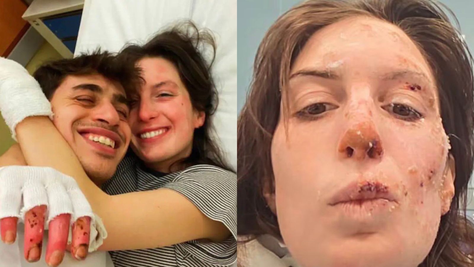 29-letna Eleonora objavila fotografije opeklin po katastrofalnem požaru v švicarskem baru