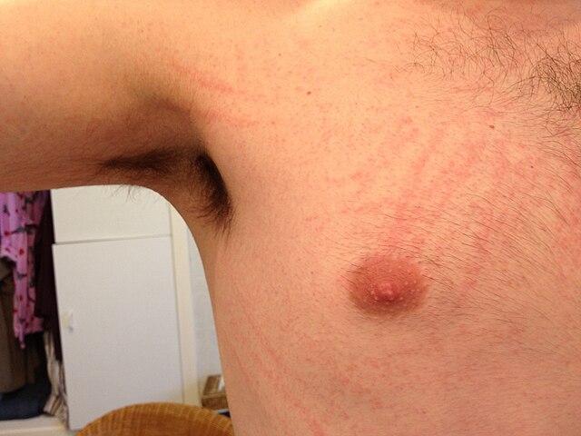 Bolezen, ki se širi po Sloveniji: Okužilo se je že več kot tisoč ljudi