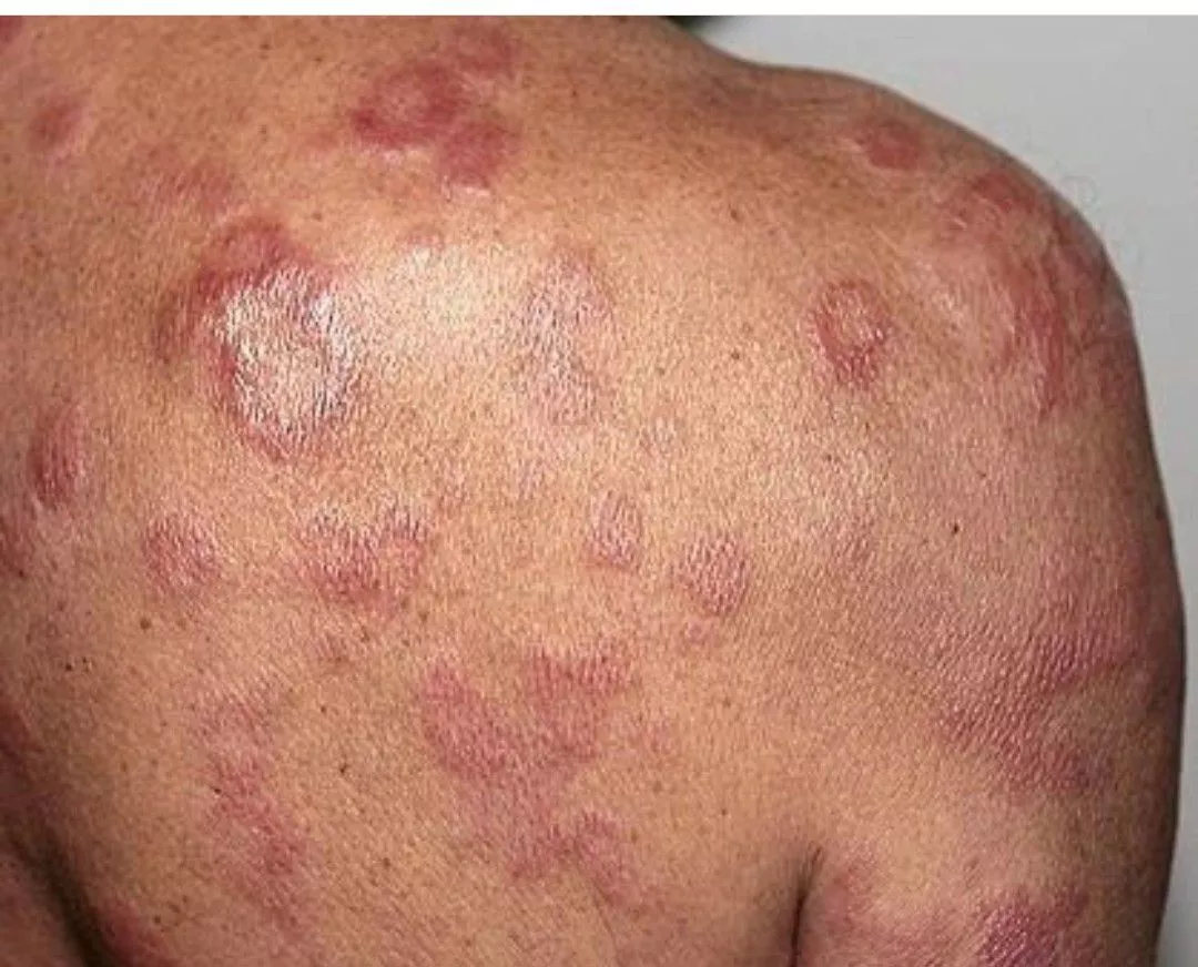 Logarjeva razkrila resnico o gobavosti: »Zmotno je mišljenje, da...«