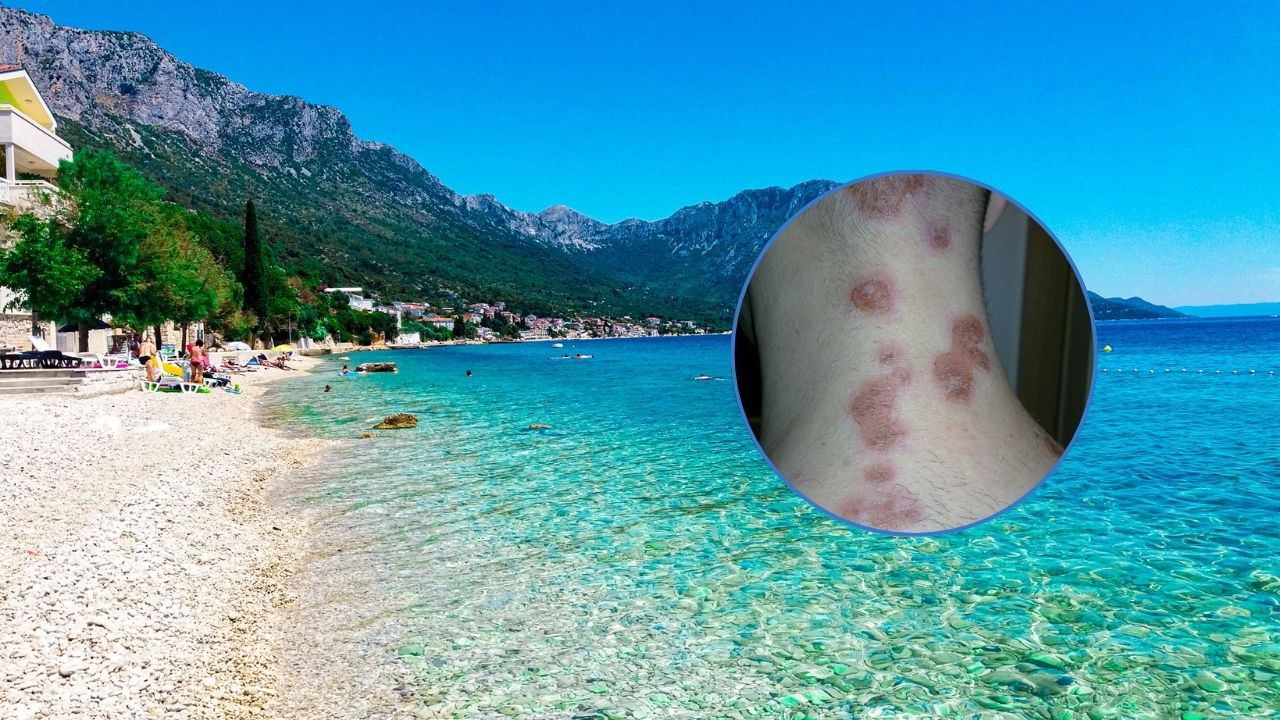 Na Hrvaškem se širi nalezljiva bakterijska okužba, kako jo preprečiti in zdraviti?