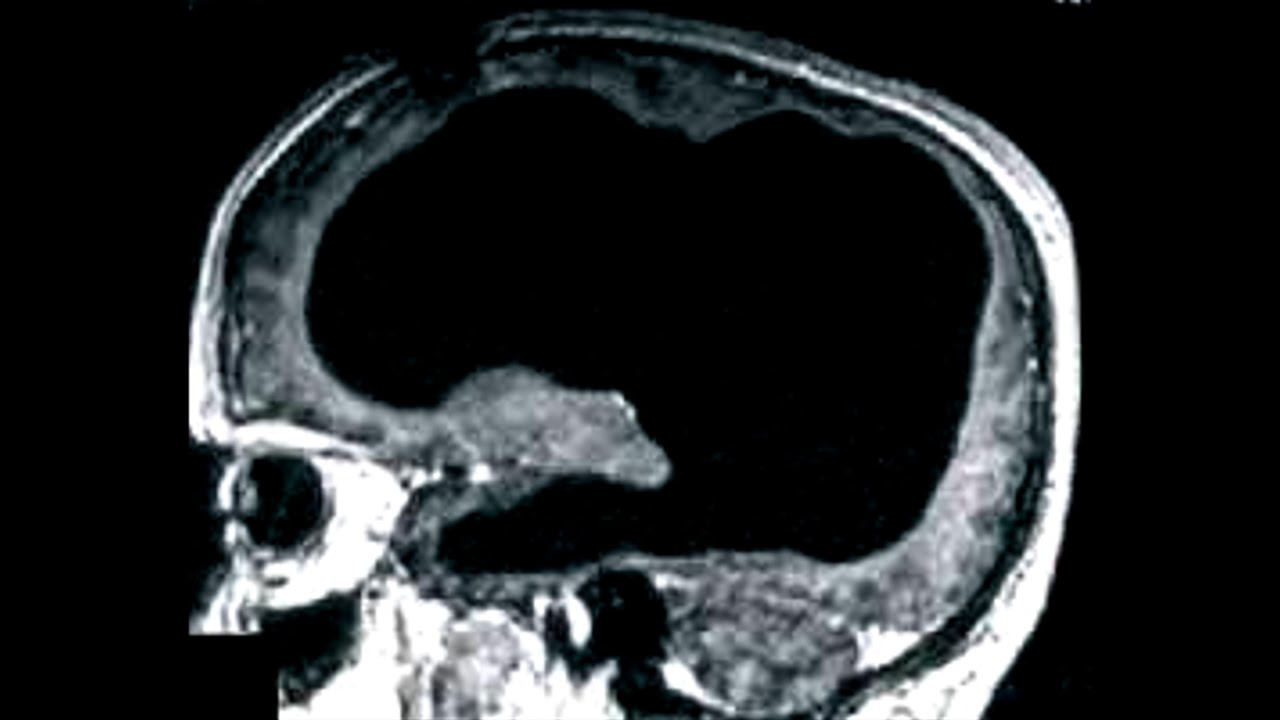 Moški delal v javnem sektorju, imel otroke in živel normalno: Nato ugotovili, da mu manjka 90 % možganov