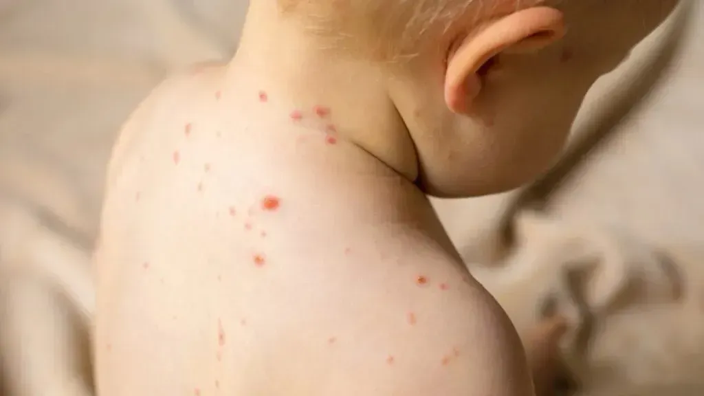 Izbruh ošpic v Londonu, okuženih več kot 60 otrok