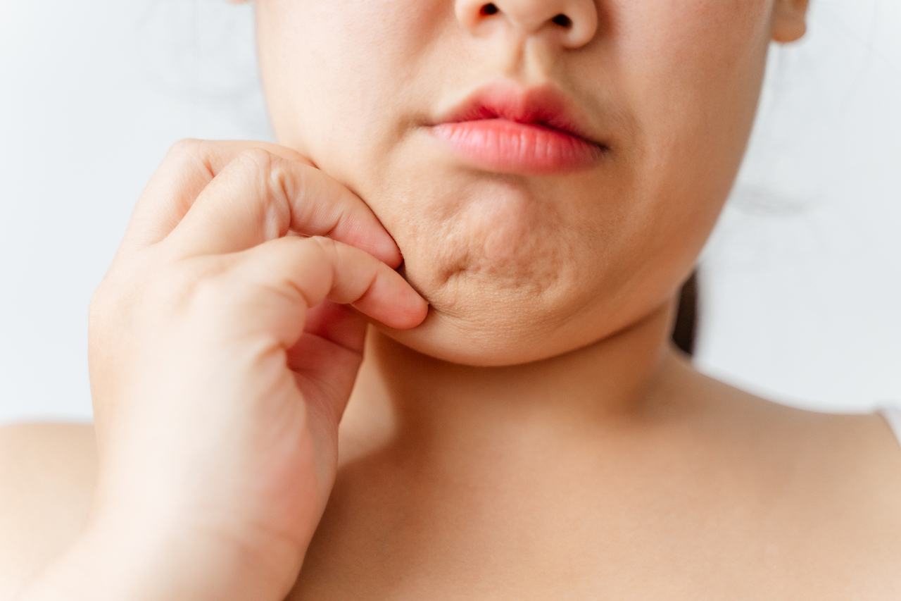 Stalno gledanje v zaslon vam lahko poveča podbradek: Kako se ga lahko znebite?